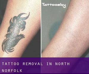 Tattoo Removal in North Norfolk