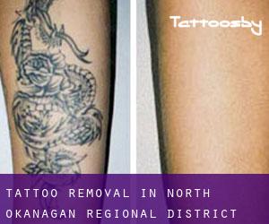 Tattoo Removal in North Okanagan Regional District