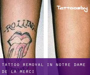 Tattoo Removal in Notre-Dame-de-la-Merci
