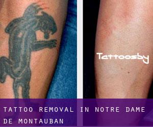Tattoo Removal in Notre-Dame-de-Montauban