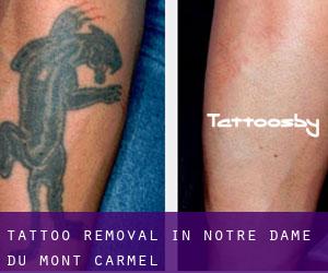 Tattoo Removal in Notre-Dame-du-Mont-Carmel