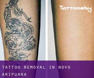 Tattoo Removal in Novo Aripuanã