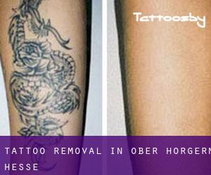 Tattoo Removal in Ober Hörgern (Hesse)