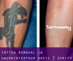 Tattoo Removal in Oberwinterthur (Kreis 2) (Zurich)
