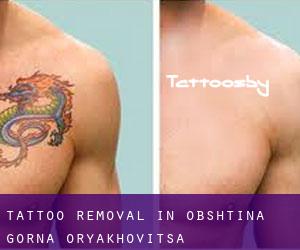 Tattoo Removal in Obshtina Gorna Oryakhovitsa