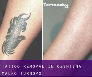 Tattoo Removal in Obshtina Malko Tŭrnovo