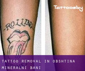 Tattoo Removal in Obshtina Mineralni Bani