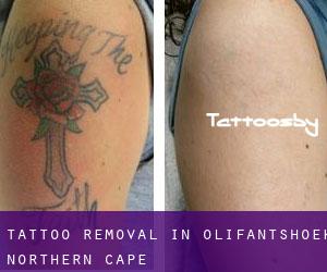 Tattoo Removal in Olifantshoek (Northern Cape)