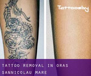 Tattoo Removal in Oraş Sânnicolau Mare