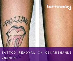 Tattoo Removal in Oskarshamns Kommun