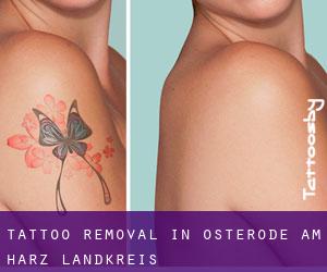 Tattoo Removal in Osterode am Harz Landkreis