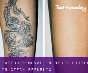 Tattoo Removal in Other Cities in Czech Republic