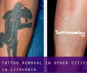 Tattoo Removal in Other Cities in Lithuania