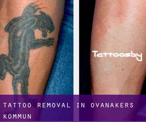 Tattoo Removal in Ovanåkers Kommun