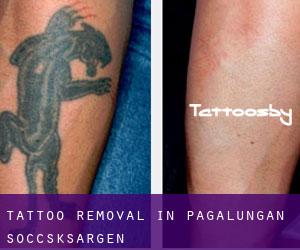 Tattoo Removal in Pagalungan (Soccsksargen)