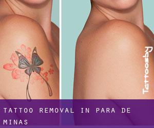 Tattoo Removal in Pará de Minas