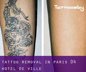Tattoo Removal in Paris 04 Hôtel-de-Ville
