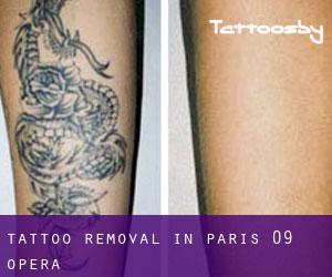 Tattoo Removal in Paris 09 Opéra