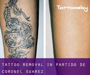 Tattoo Removal in Partido de Coronel Suárez