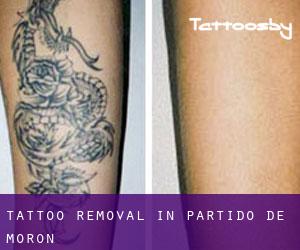 Tattoo Removal in Partido de Morón