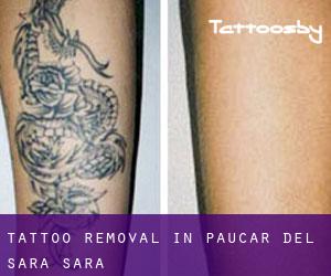 Tattoo Removal in Paucar Del Sara Sara