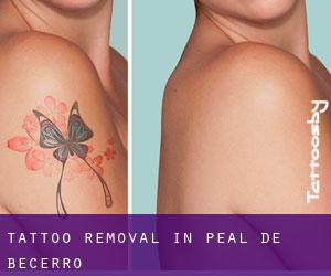 Tattoo Removal in Peal de Becerro