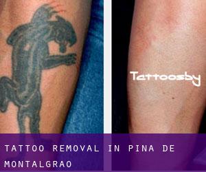 Tattoo Removal in Pina de Montalgrao