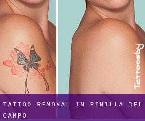 Tattoo Removal in Pinilla del Campo