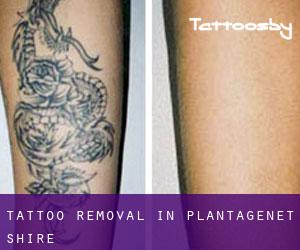 Tattoo Removal in Plantagenet Shire
