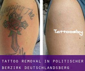 Tattoo Removal in Politischer Berzirk Deutschlandsberg