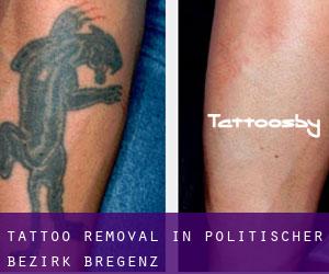 Tattoo Removal in Politischer Bezirk Bregenz