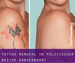 Tattoo Removal in Politischer Bezirk Gänserndorf