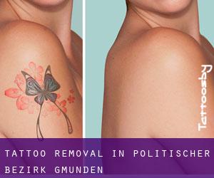 Tattoo Removal in Politischer Bezirk Gmunden