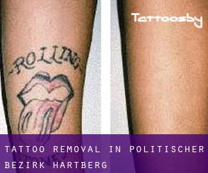 Tattoo Removal in Politischer Bezirk Hartberg