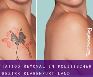 Tattoo Removal in Politischer Bezirk Klagenfurt Land