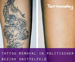 Tattoo Removal in Politischer Bezirk Knittelfeld