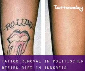 Tattoo Removal in Politischer Bezirk Ried im Innkreis