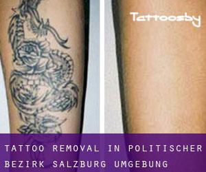 Tattoo Removal in Politischer Bezirk Salzburg Umgebung
