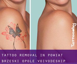 Tattoo Removal in Powiat brzeski (Opole Voivodeship)