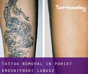 Tattoo Removal in Powiat krośnieński (Lubusz)