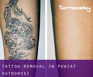 Tattoo Removal in Powiat kutnowski