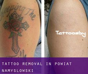Tattoo Removal in Powiat namysłowski