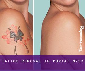Tattoo Removal in Powiat nyski