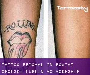 Tattoo Removal in Powiat opolski (Lublin Voivodeship)