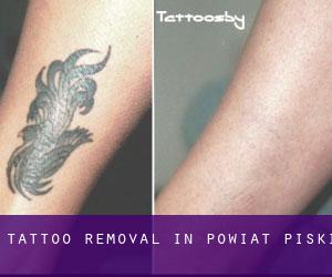 Tattoo Removal in Powiat piski