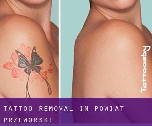 Tattoo Removal in Powiat przeworski