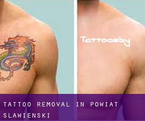 Tattoo Removal in Powiat sławieński