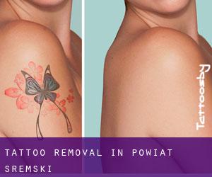 Tattoo Removal in Powiat śremski
