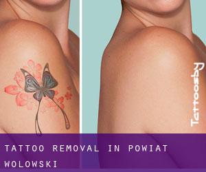 Tattoo Removal in Powiat wołowski