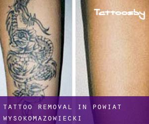 Tattoo Removal in Powiat wysokomazowiecki